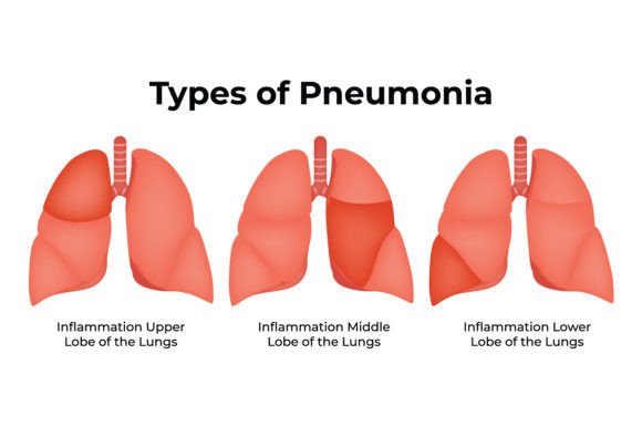 Download Types of Pneumonia Science Design Vector - Premium Bundle