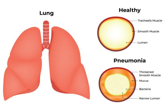Download Lung Healthy Pneumonia Science Design - Premium Bundle